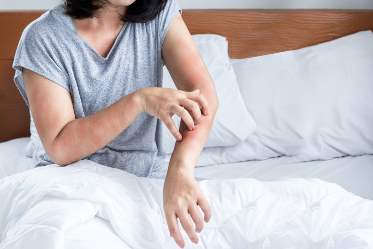 如不幸被床蝨叮咬，可能會出現紅疹、痕癢等床蝨初期症狀